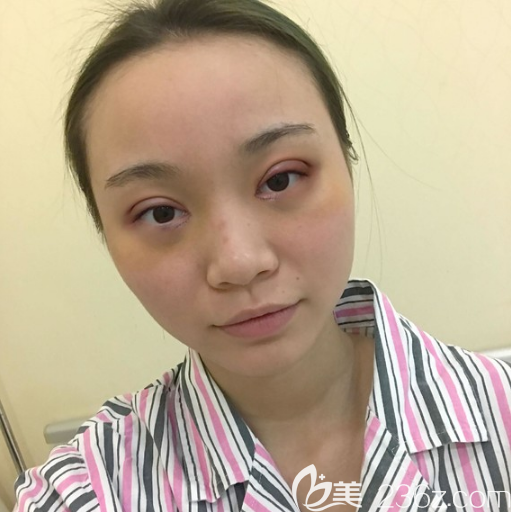 廣州余花醫(yī)生雙眼皮術(shù)后7天效果圖 廣州余花醫(yī)生雙眼皮術(shù)后7天效果圖
