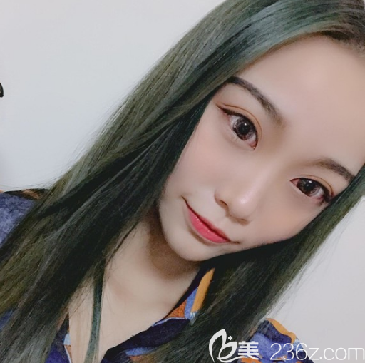 廣州愛來整形醫(yī)院余花雙眼皮案例一個月效果 廣州愛來整形醫(yī)院余花雙眼皮案例一個月效果