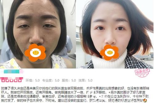 福州美貝爾趙棟材醫(yī)生切開雙眼皮+開眼角前后對(duì)比圖