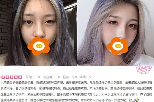 福州美貝爾趙棟材醫(yī)生做鼻綜合術(shù)前術(shù)后對(duì)比照