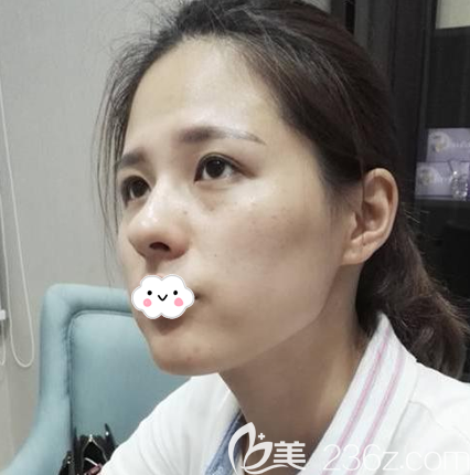 看網(wǎng)上評價說廣州軍美王世虎做脂肪填充技術(shù)特別好于是專程過來找他做了全臉脂肪填充 看網(wǎng)上評價說廣州軍美王世虎做脂肪填充技術(shù)特別好于是專程過來找他做了全臉脂肪填充