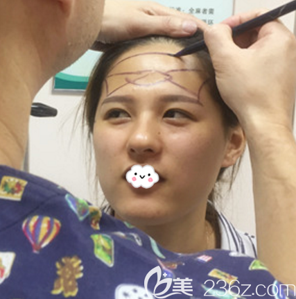 廣州軍美王世虎脂肪填充術(shù)前畫線 廣州軍美王世虎脂肪填充術(shù)前畫線