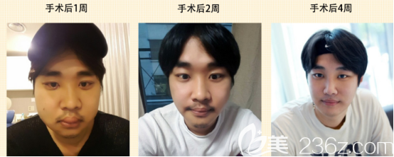 閔龍奎術(shù)后4周的變化情況 閔龍奎術(shù)后4周的變化情況