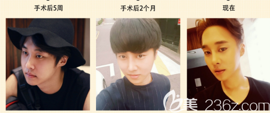 閔龍奎術(shù)后兩個(gè)月的變化情況 閔龍奎術(shù)后兩個(gè)月的變化情況