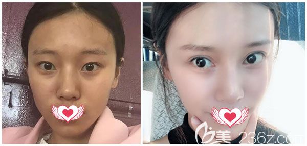 <!--<i data=20240703-sp></i>-->美萊<!--<i data=20240703-sp></i>-->做自體脂肪填充法令紋前后照片