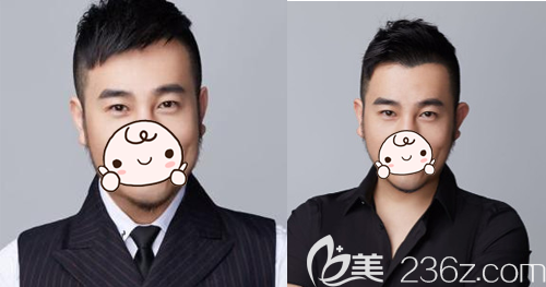 用對比照片記錄我找植發(fā)醫(yī)院徐霞做發(fā)際線種植一年內(nèi)的真實變化