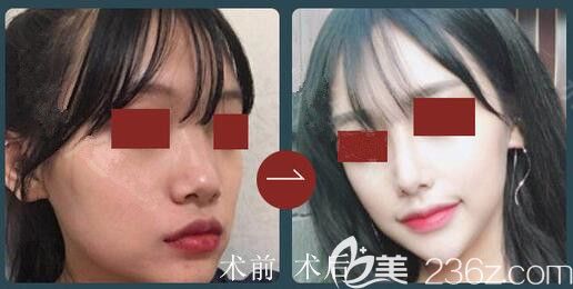 韓國(guó)高恩世上鼻修復(fù)案例