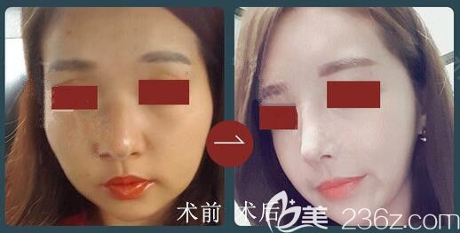 李炳澮隆鼻好不好？