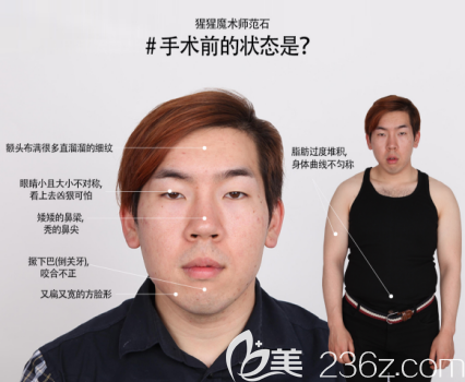 全范石術(shù)前模樣 全范石術(shù)前模樣