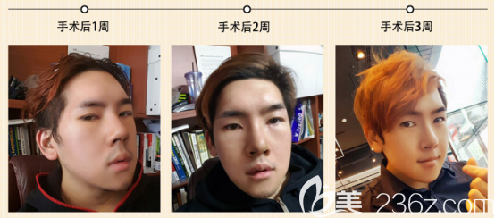 全范石術(shù)后三周的樣子