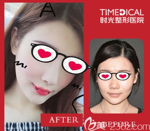 蘭州時光逯巖院長硅膠隆鼻+鼻頭鼻翼縮小效果案例