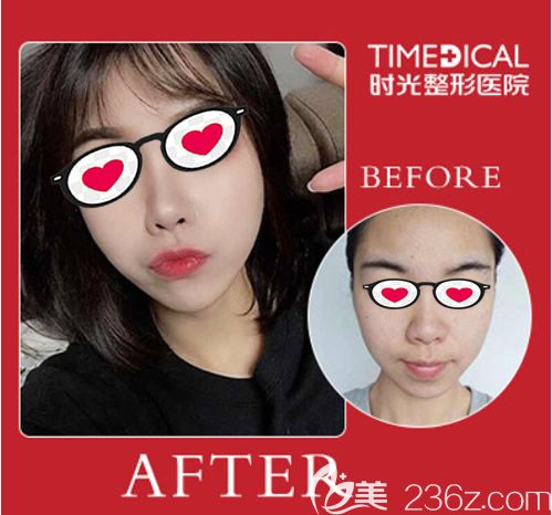 蘭州時光羅梅醫(yī)生肋軟骨隆鼻前后對比照片