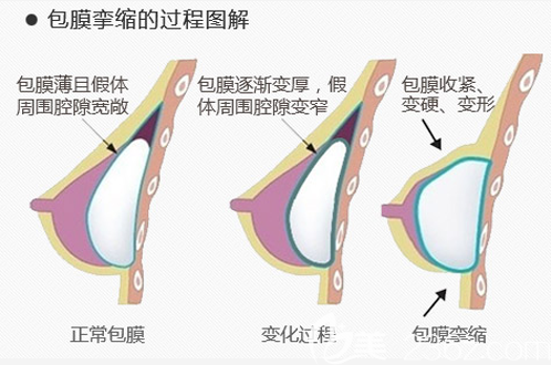包膜攣縮是如何形成的