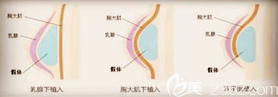 雙平面植入假體