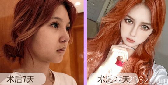 半肋軟骨鼻綜合第7天和22天效果