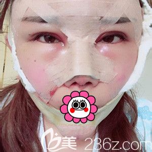 寧波童顏依美做完隆鼻和墊下巴手術(shù)后即刻 寧波童顏依美做完隆鼻和墊下巴手術(shù)后即刻