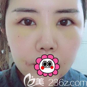 術(shù)后7天拆線后恢復(fù)的<span style= 術(shù)后7天拆線后恢復(fù)的<span style=