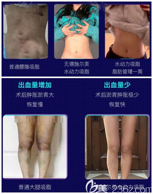 無錫施爾美吸脂效果 無錫施爾美吸脂效果
