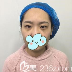 到太原時(shí)光做埋線雙眼皮前的自己 到太原時(shí)光做埋線雙眼皮前的自己