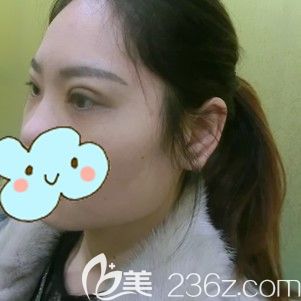 李醫(yī)生幫我做埋線雙眼皮術(shù)后4天眼部腫脹 李醫(yī)生幫我做埋線雙眼皮術(shù)后4天眼部腫脹