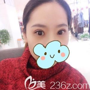 在太原時(shí)光做埋線提升術(shù)后15天線條流暢 在太原時(shí)光做埋線提升術(shù)后15天線條流暢