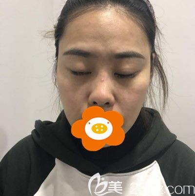 找廈門薇格高勇醫(yī)生做肋軟骨隆鼻前照片 找廈門薇格高勇醫(yī)生做肋軟骨隆鼻前照片