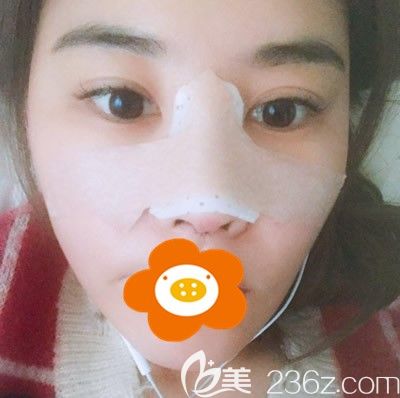 隆鼻后第三天鼻子上貼著膠帶 隆鼻后第三天鼻子上貼著膠帶