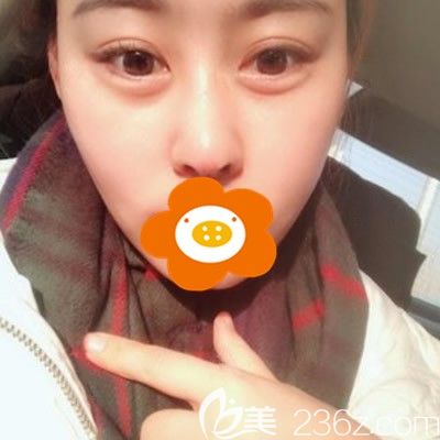 高勇醫(yī)生為我做鼻子后一周剛拆線 高勇醫(yī)生為我做鼻子后一周剛拆線