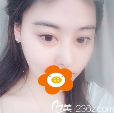 做綜合隆鼻手術(shù)半個(gè)月鼻子還有點(diǎn)腫 做綜合隆鼻手術(shù)半個(gè)月鼻子還有點(diǎn)腫