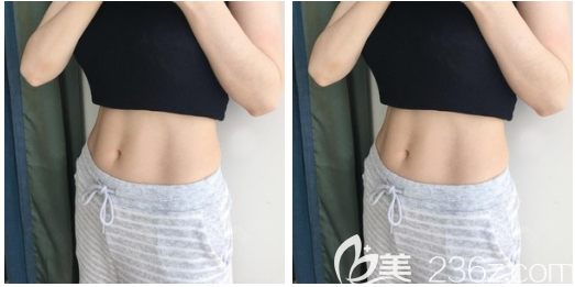 我的馬甲線就是找佛山曙光金子整形醫(yī)院李淑薇醫(yī)生通過腰腹部吸脂吸出來的哦
