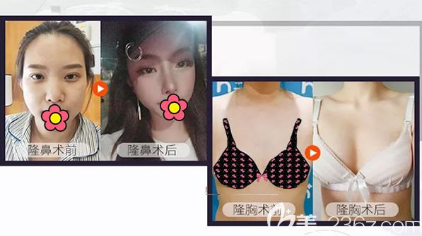 呼和浩特華醫(yī)整形做了自體脂肪豐胸和耳軟骨隆鼻效果 呼和浩特華醫(yī)整形做了自體脂肪豐胸和耳軟骨隆鼻效果