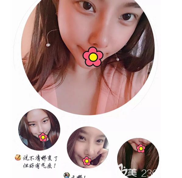 真人案例:我來說說北京妹子為什么來呼和浩特華醫(yī)整形做自體脂肪豐胸和耳軟骨隆鼻！