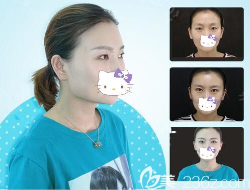 <!--<i data=20240703-sp></i>-->的曹洪揚院長做切開雙眼皮<span style=