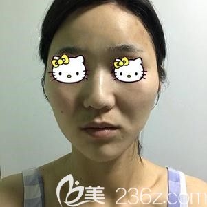 做面部脂肪填充前一直被稱作“寡婦臉”的自己 做面部脂肪填充前一直被稱作“寡婦臉”的自己