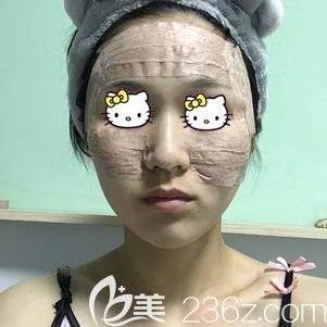 張國軍幫我做自體脂肪面部填充術后即刻 張國軍幫我做自體脂肪面部填充術后即刻