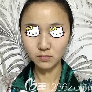 做自體脂肪面部填充術后15天腫脹輕微 做自體脂肪面部填充術后15天腫脹輕微