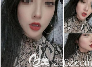 術(shù)后60天 術(shù)后60天