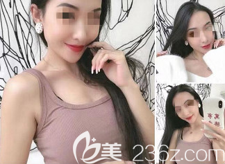 術(shù)后90天的樣子 術(shù)后90天的樣子