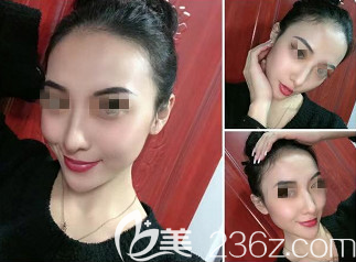 西安高一生整形醫(yī)院正規(guī)靠譜，所以我選擇高一生做全面部脂肪填充手術(shù)