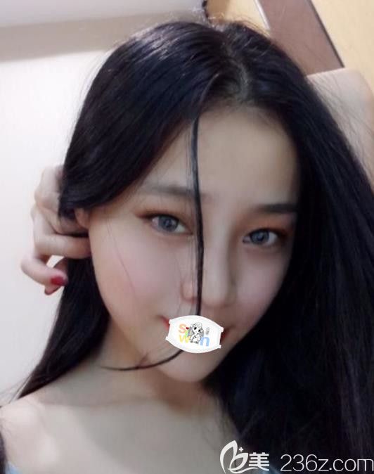 找孝感天妃柳肖給我做假體隆鼻綜合整形價格比心理預(yù)期費用低真開心！