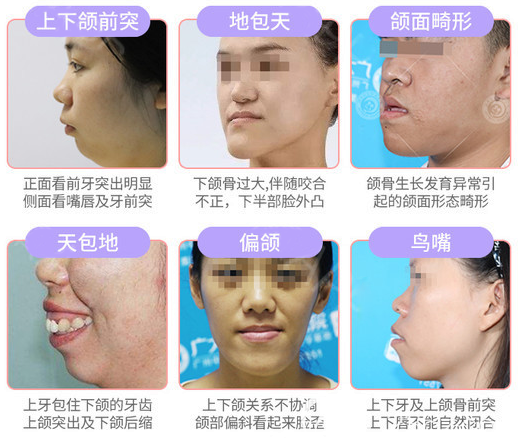 偏頜導致臉歪怎么辦