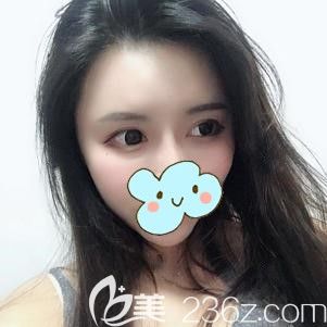 不得不說(shuō)在太原時(shí)光做的這個(gè)自體脂肪豐額頭真的是讓顏值更上一層樓，真的效果太棒啦