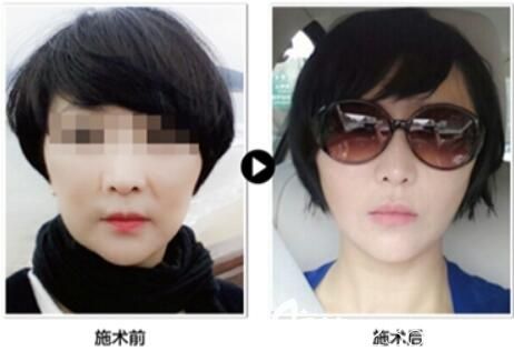 韓國普羅菲耳醫(yī)院小切口提升案例 韓國普羅菲耳醫(yī)院小切口提升案例