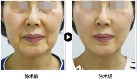 韓國profile醫(yī)院樸明旭院長小切口提升案例 韓國profile醫(yī)院樸明旭院長小切口提升案例