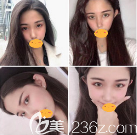 我用面部自體脂肪填充日記告訴你西安葉子整形醫(yī)院到底正規(guī)靠譜嗎？