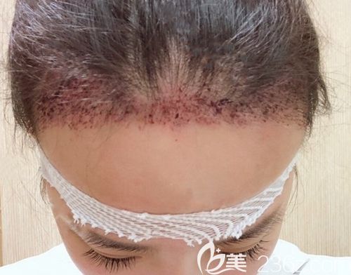 重慶華美發(fā)際線種植手術(shù)當(dāng)天 重慶華美發(fā)際線種植手術(shù)當(dāng)天