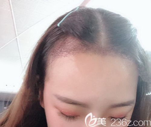 重慶華美發(fā)際線種植手術(shù)后3天 重慶華美發(fā)際線種植手術(shù)后3天