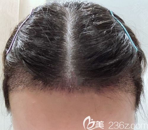 重慶華美發(fā)際線種植術(shù)后7天 重慶華美發(fā)際線種植術(shù)后7天