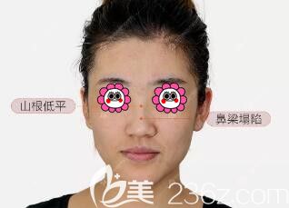 在沈陽百嘉麗做鼻整形術(shù)前照 在沈陽百嘉麗做鼻整形術(shù)前照