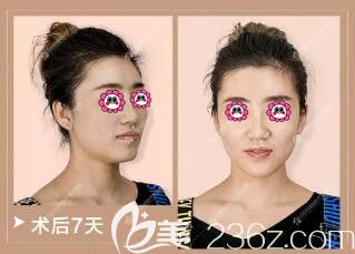 做超體+自體軟骨隆鼻術(shù)后一周效果 做超體+自體軟骨隆鼻術(shù)后一周效果